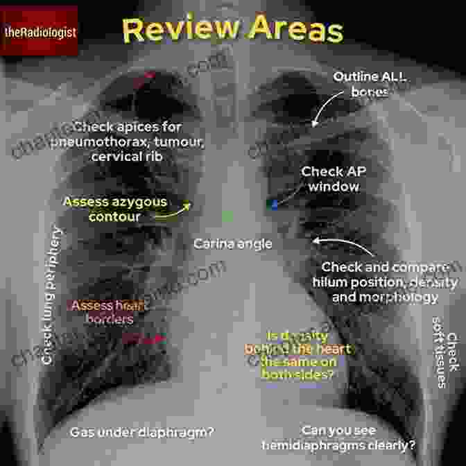 Interpretation Of Chest Radiographs Systematic Approach And Common Patterns What Radiology Residents Need To Know: Chest Radiology