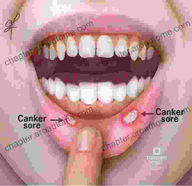 Mouth Ulcers Are Small, Painful Sores That Can Occur In The Mouth. They Are Most Commonly Caused By Irritation Or Injury To The Mouth, Such As Biting Your Cheek, Eating Hot Food, Or Brushing Your Teeth Too Hard. Mouth Ulcers Can Also Be Caused By Certain Medical Conditions, Such As Canker Sores, Cold Sores, And Herpes Simplex Virus. Cure Mouth Ulcers: The Causes Treatment Prevention