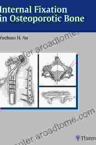 Internal Fixation In Osteoporotic Bone