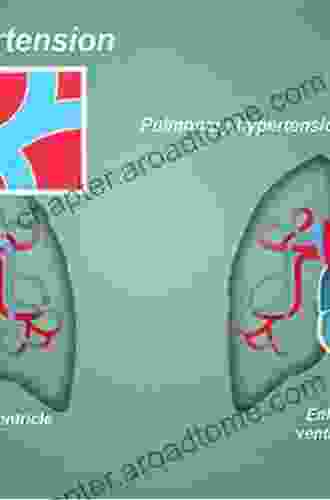 Pulmonary Arterial Hypertension (The Facts)